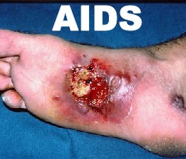 AIDS Cancer