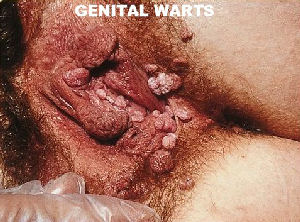 Female Genital Warts
