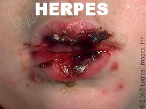 Oral Herpes