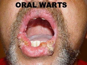 Oral Warts