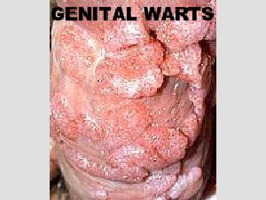 Anal Warts