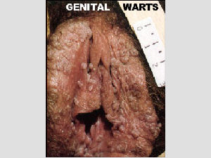 Scary Vaginal Warts