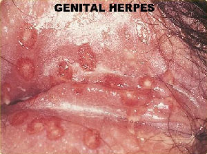 Vaginal Herpes